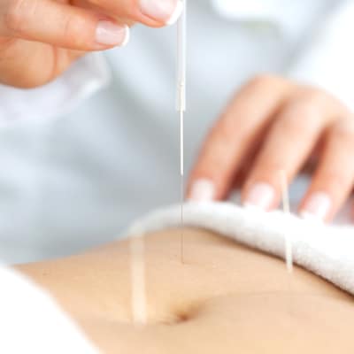 ACUPUNCTURE